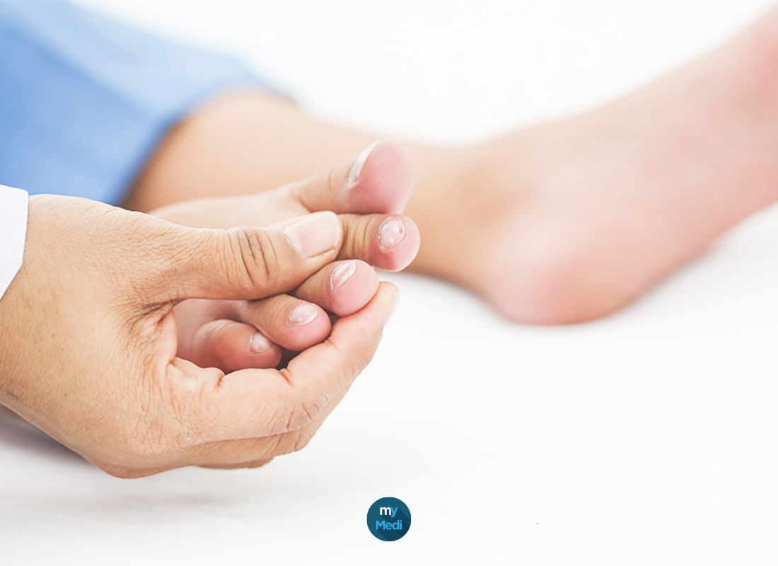 Orteil en marteau ou orteil en griffe : que faire ?