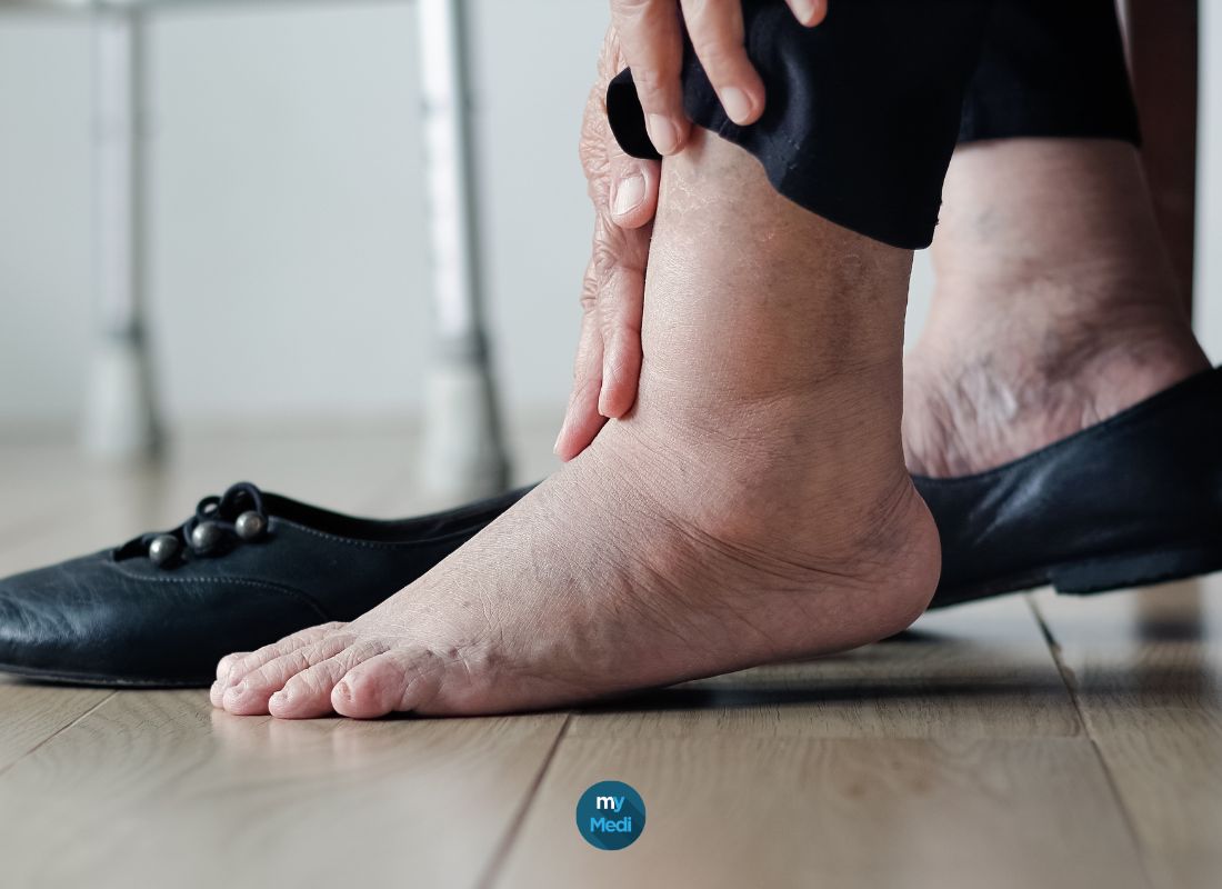 Pieds gonflés : les signes alarmants