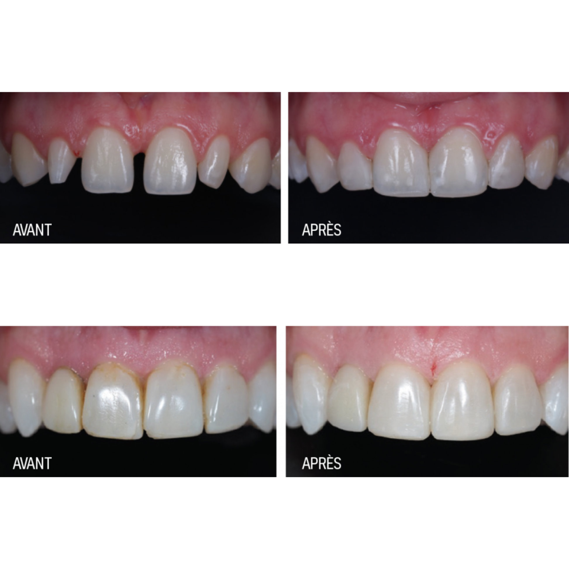 Luna 2 - composite universel - 4 g - plusieurs teintes - SDI - My Médical