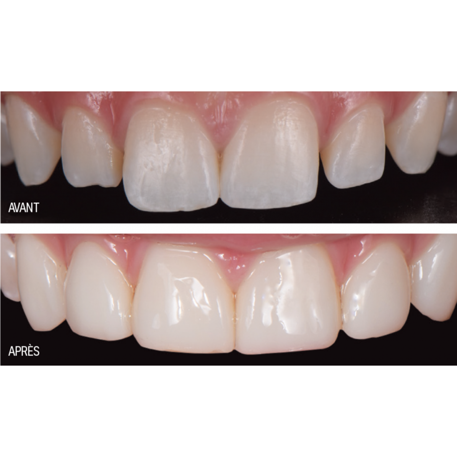 Luna 2 - composite universel - 4 g - plusieurs teintes - SDI - My Médical