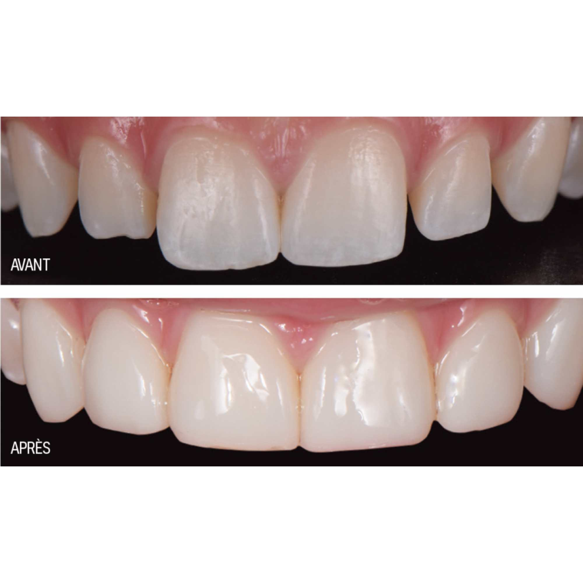 Luna 2 - composite universel - 4 g - plusieurs teintes - SDI - My Médical